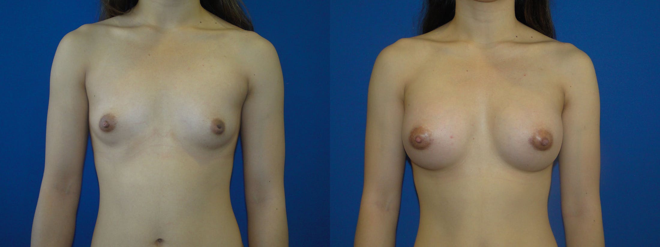 Breast Augmentation Before & After Gallery - Patient 74818600 - Image 1