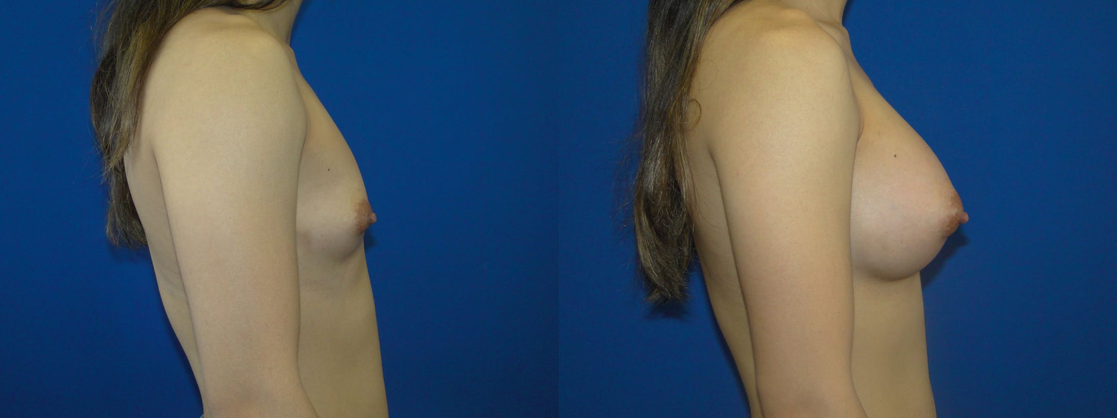 Breast Augmentation Before & After Gallery - Patient 74818600 - Image 2