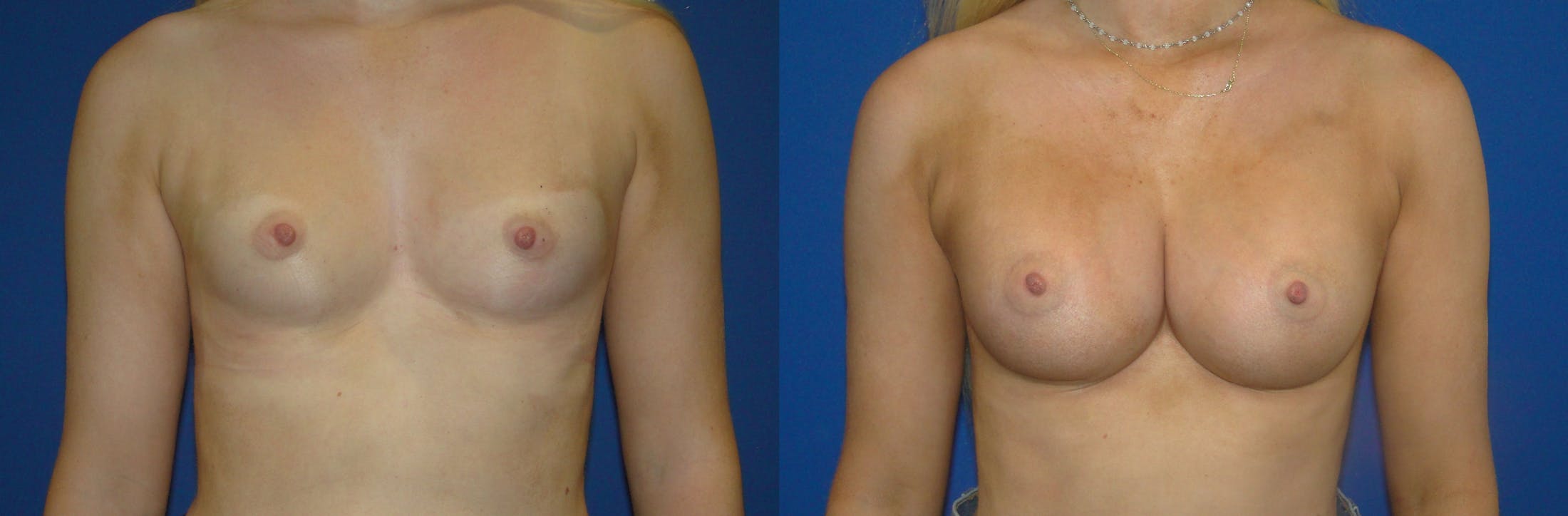Breast Augmentation Before & After Gallery - Patient 74822832 - Image 1
