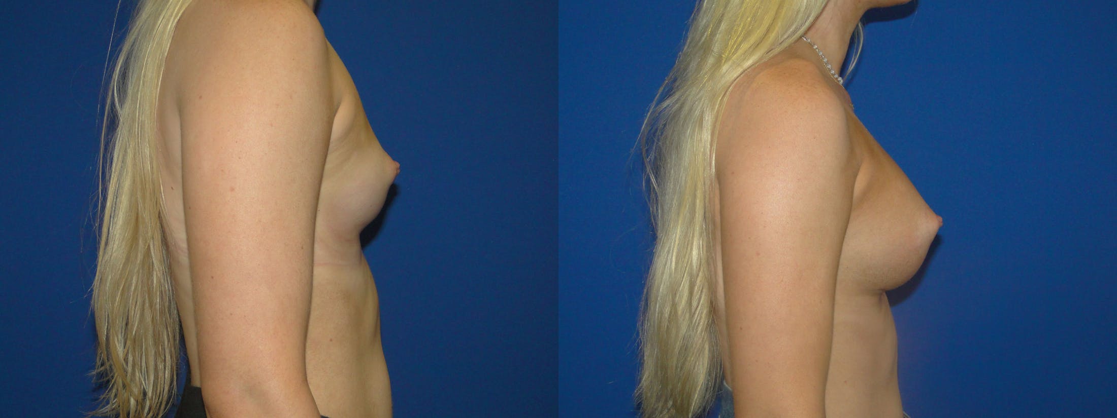 Breast Augmentation Before & After Gallery - Patient 74822832 - Image 2