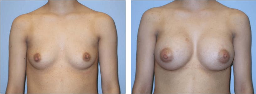 Breast Augmentation Before & After Gallery - Patient 74822835 - Image 1