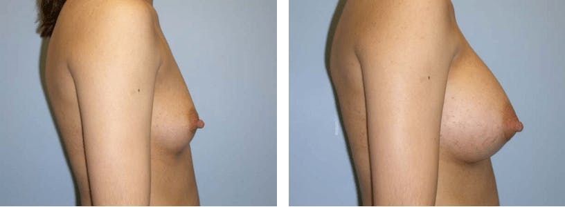 Breast Augmentation Before & After Gallery - Patient 74822835 - Image 2