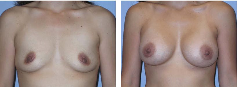 Breast Augmentation Before & After Gallery - Patient 74822836 - Image 1