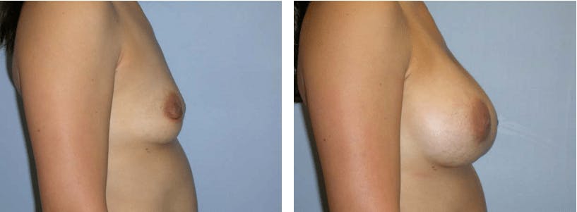 Breast Augmentation Before & After Gallery - Patient 74822836 - Image 2