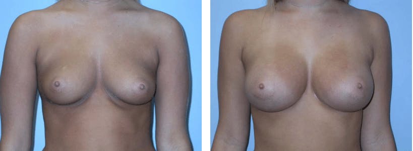 Breast Augmentation Before & After Gallery - Patient 74822841 - Image 1