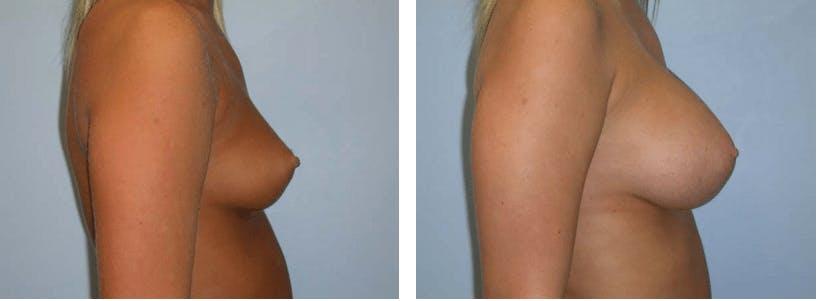 Breast Augmentation Before & After Gallery - Patient 74822841 - Image 2