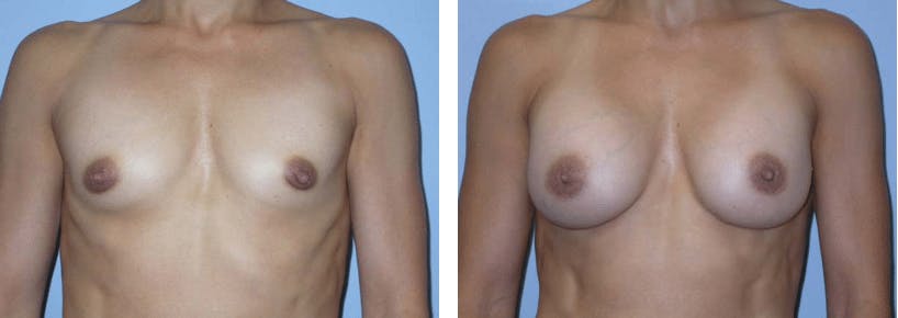 Breast Augmentation Before & After Gallery - Patient 74822842 - Image 1
