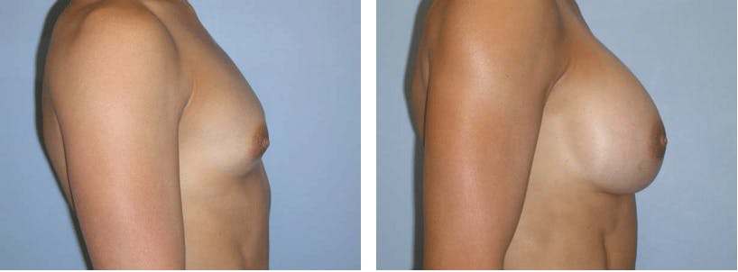 Breast Augmentation Before & After Gallery - Patient 74822842 - Image 2