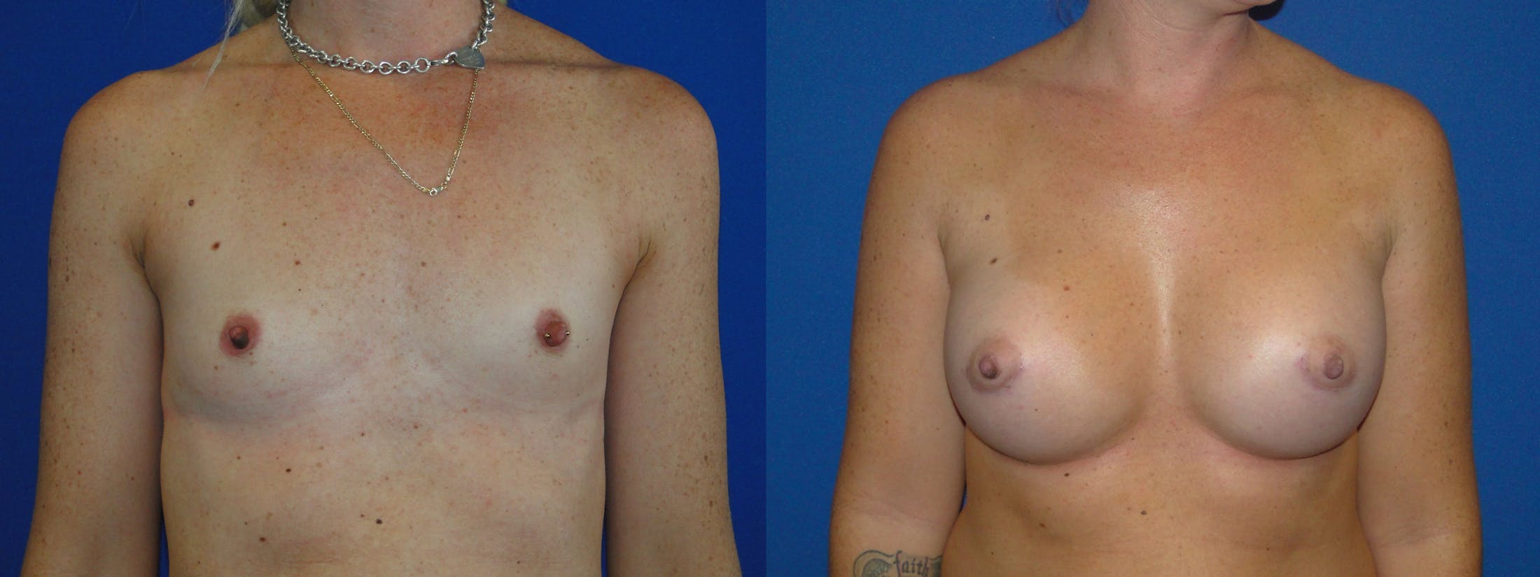 Breast Augmentation Before & After Gallery - Patient 74822843 - Image 1