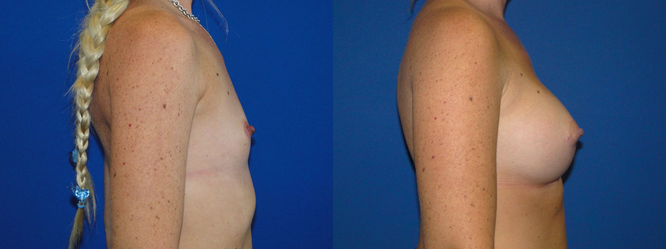 Breast Augmentation Before & After Gallery - Patient 74822843 - Image 2