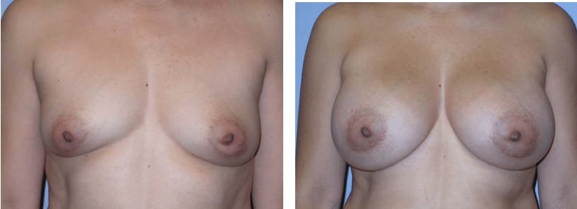 Breast Augmentation Before & After Gallery - Patient 74822978 - Image 1