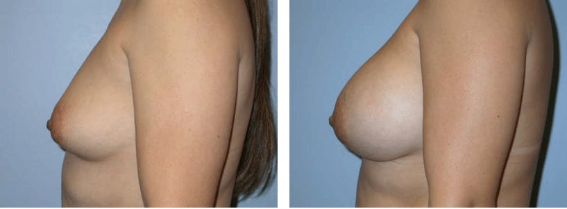 Breast Augmentation Before & After Gallery - Patient 74822978 - Image 2