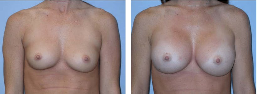 Breast Augmentation Gallery - Patient 74822979 - Image 1