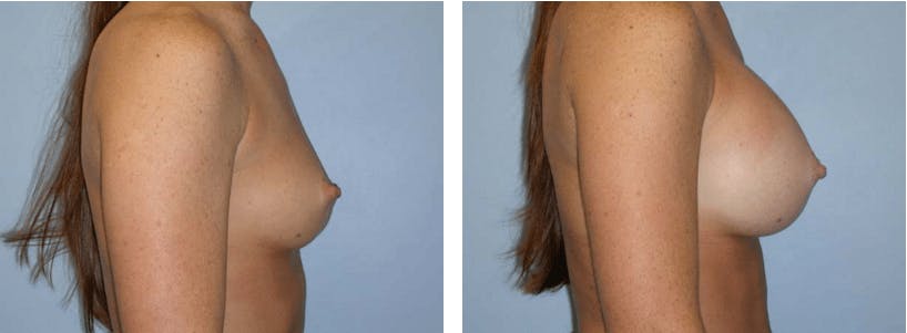 Breast Augmentation Gallery - Patient 74822979 - Image 2