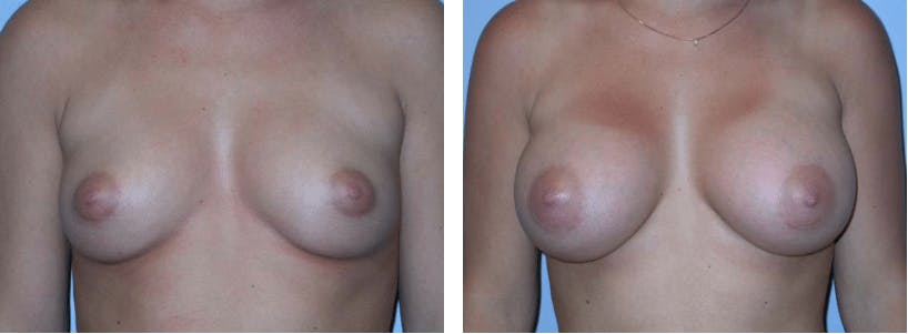 Breast Augmentation Before & After Gallery - Patient 74822980 - Image 1
