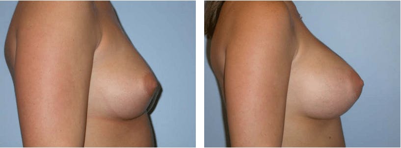 Breast Augmentation Before & After Gallery - Patient 74822980 - Image 2