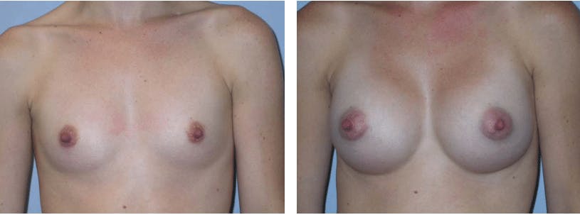Breast Augmentation Before & After Gallery - Patient 74822981 - Image 1
