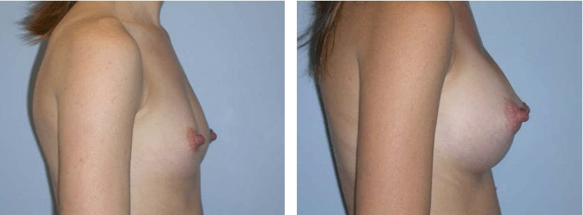 Breast Augmentation Before & After Gallery - Patient 74822981 - Image 2