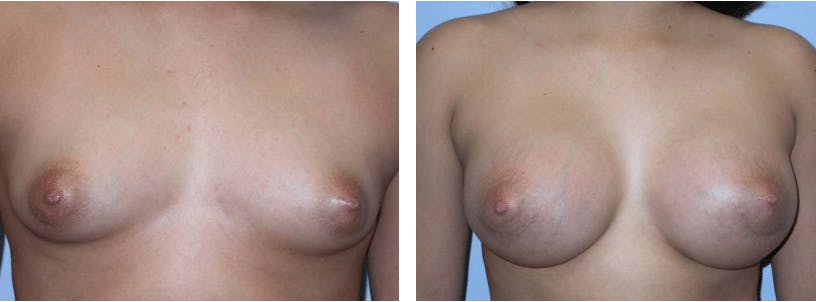 Breast Augmentation Before & After Gallery - Patient 74822982 - Image 1