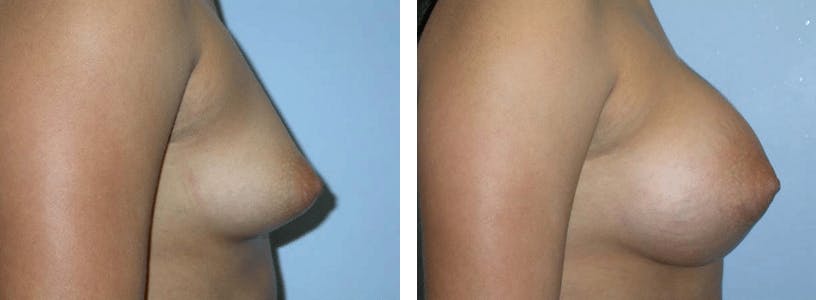 Breast Augmentation Before & After Gallery - Patient 74822982 - Image 2