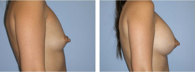 Breast Augmentation Before & After Gallery - Patient 74822984 - Image 2