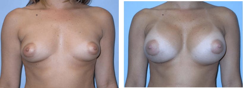 Breast Augmentation Before & After Gallery - Patient 74822986 - Image 1