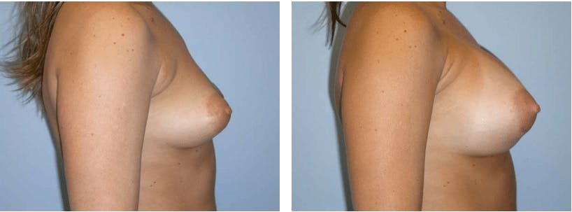 Breast Augmentation Before & After Gallery - Patient 74822986 - Image 2