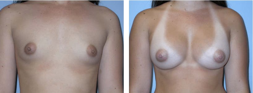 Breast Augmentation Before & After Gallery - Patient 74822990 - Image 1