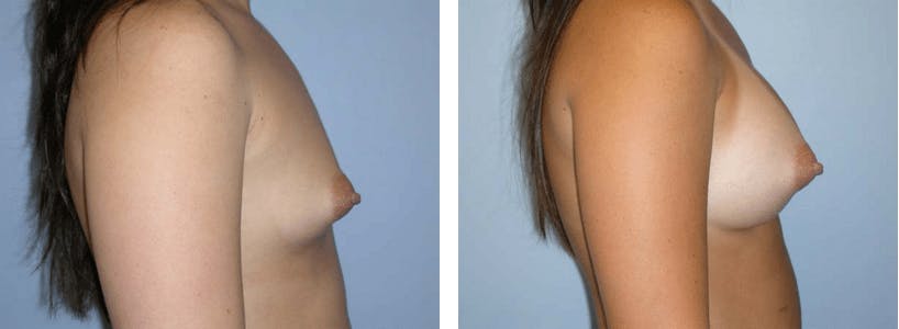 Breast Augmentation Before & After Gallery - Patient 74822990 - Image 2