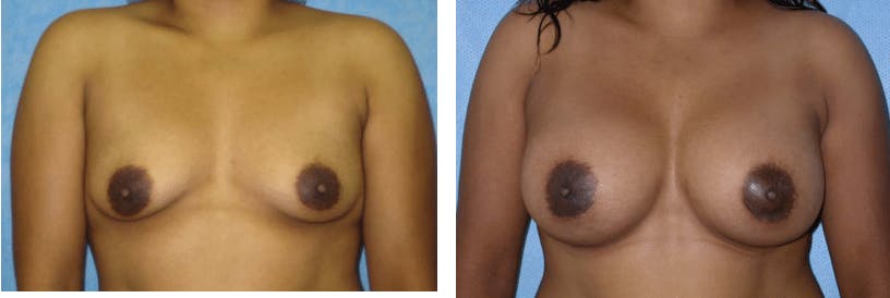 Breast Augmentation Before & After Gallery - Patient 74822992 - Image 1