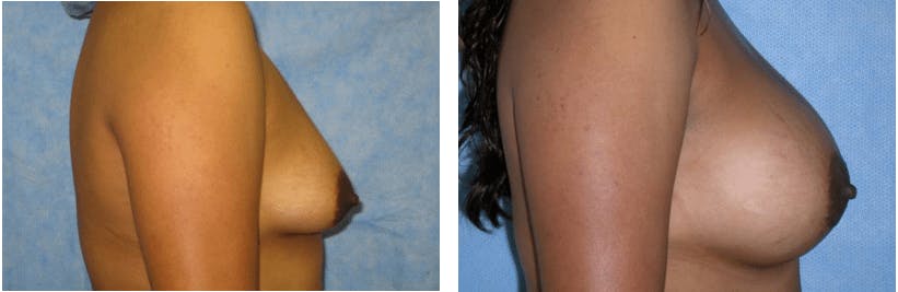 Breast Augmentation Before & After Gallery - Patient 74822992 - Image 2