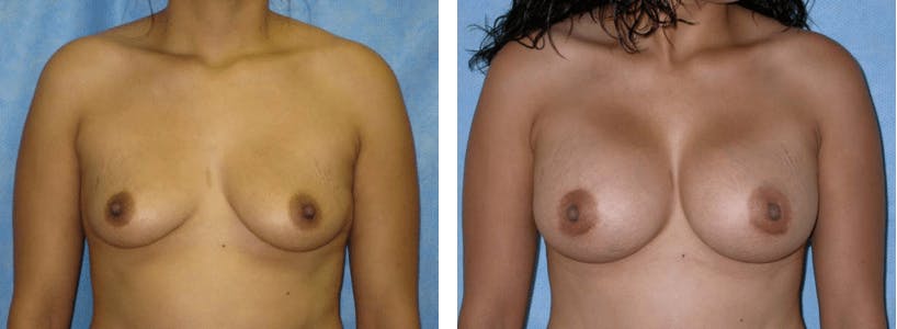 Breast Augmentation Before & After Gallery - Patient 74822995 - Image 1