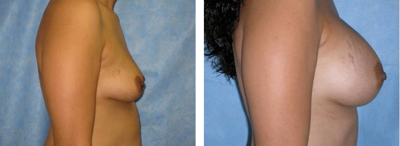 Breast Augmentation Before & After Gallery - Patient 74822995 - Image 2