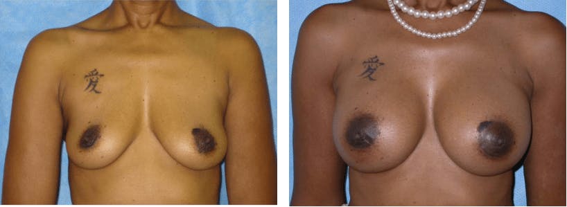 Breast Augmentation Before & After Gallery - Patient 74822997 - Image 1