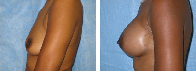 Breast Augmentation Before & After Gallery - Patient 74822997 - Image 2