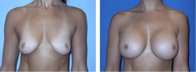 Breast Augmentation Before & After Gallery - Patient 74822999 - Image 1