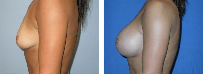 Breast Augmentation Before & After Gallery - Patient 74822999 - Image 2