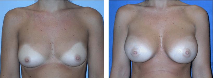 Breast Augmentation Gallery - Patient 74823000 - Image 1