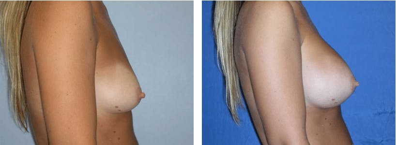 Breast Augmentation Before & After Gallery - Patient 74823000 - Image 2