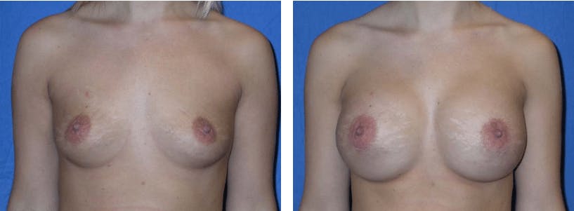 Breast Augmentation Gallery - Patient 74823001 - Image 1