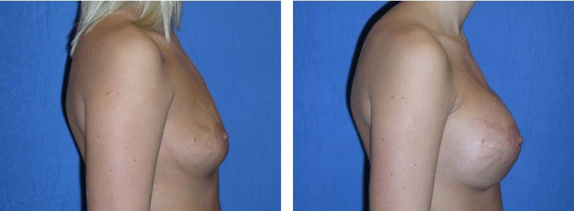 Breast Augmentation Gallery - Patient 74823001 - Image 2