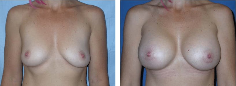 Breast Augmentation Before & After Gallery - Patient 74823002 - Image 1