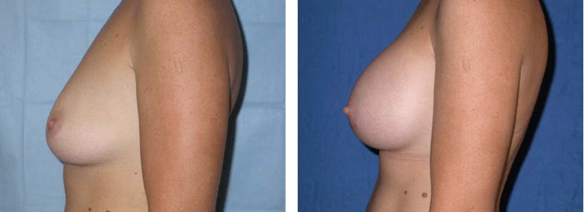 Breast Augmentation Before & After Gallery - Patient 74823002 - Image 2