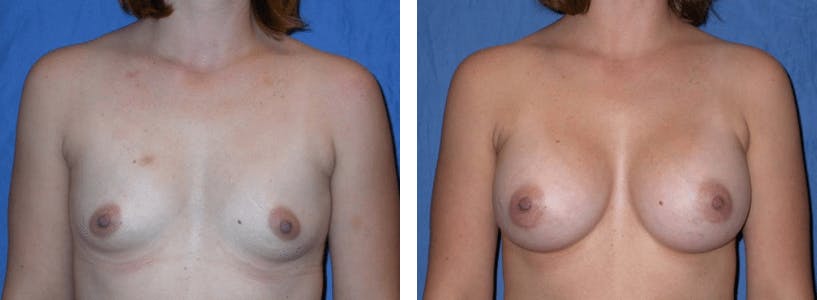 Breast Augmentation Before & After Gallery - Patient 74823003 - Image 1