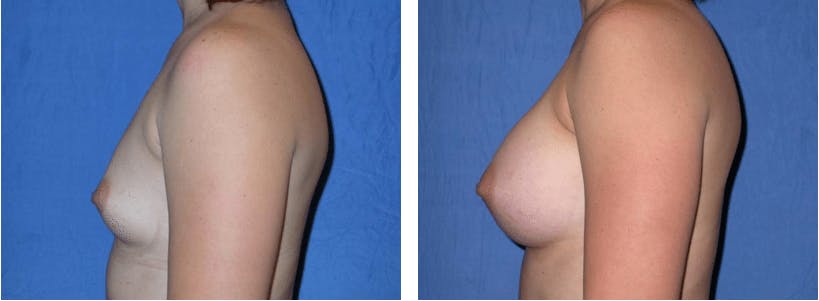 Breast Augmentation Before & After Gallery - Patient 74823003 - Image 2