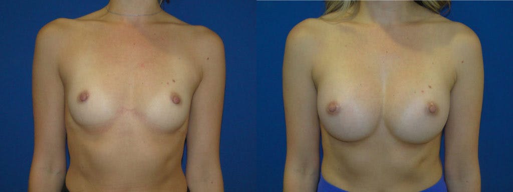 Breast Augmentation Before & After Gallery - Patient 74823005 - Image 1