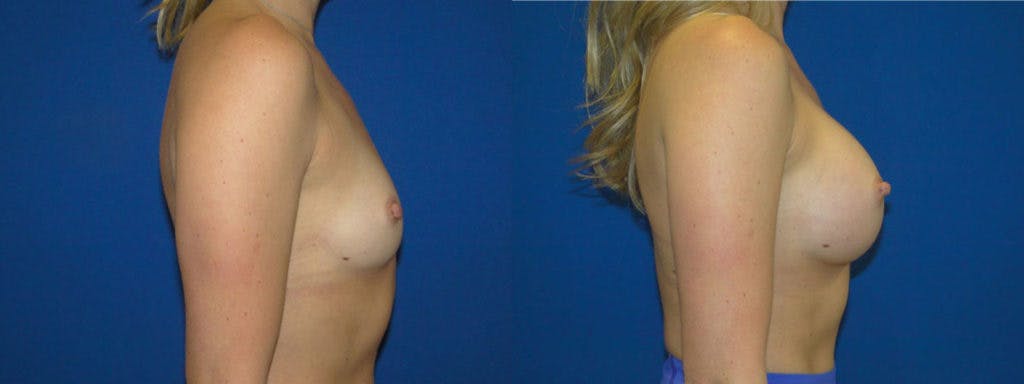 Breast Augmentation Before & After Gallery - Patient 74823005 - Image 2