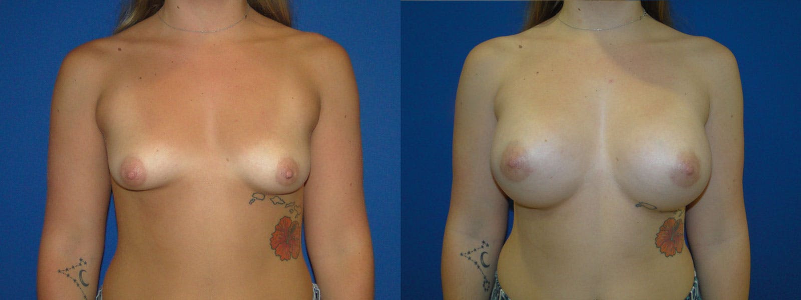 Breast Augmentation Before & After Gallery - Patient 74823006 - Image 1