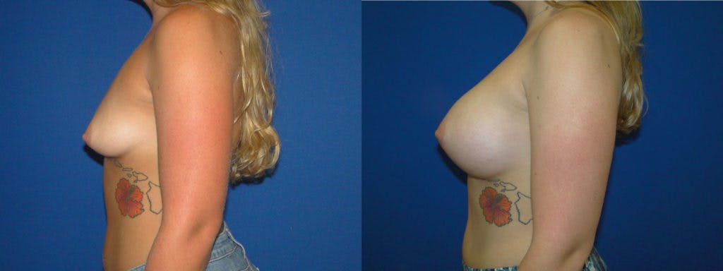 Breast Augmentation Before & After Gallery - Patient 74823006 - Image 2