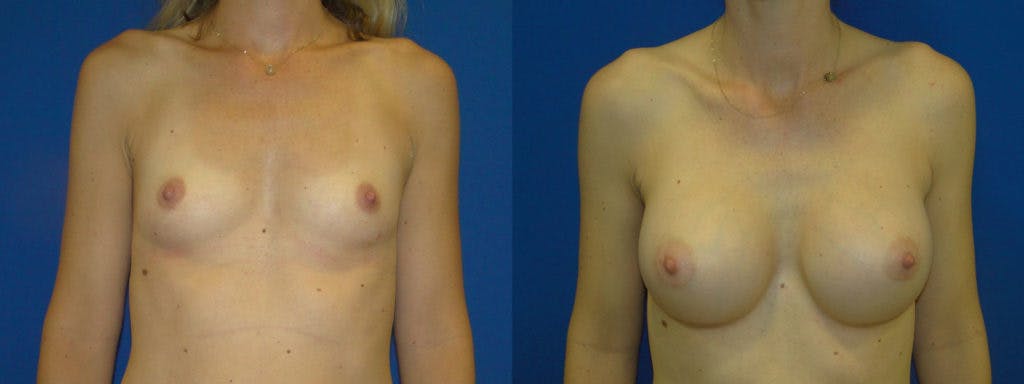 Breast Augmentation Gallery - Patient 74823007 - Image 1
